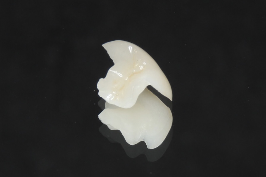 エステニア（硬質レジン）