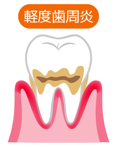 歯肉炎（軽度）