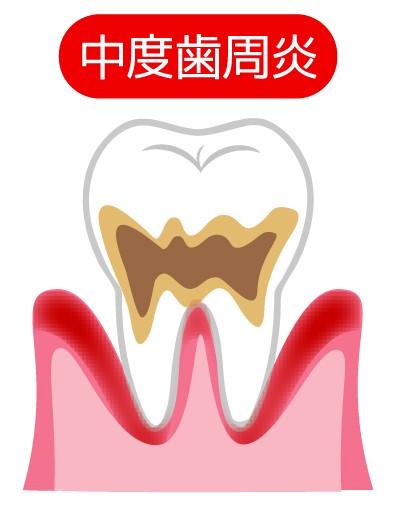 歯周炎（中等度）
