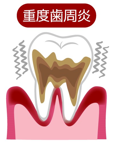 歯周炎（重度）